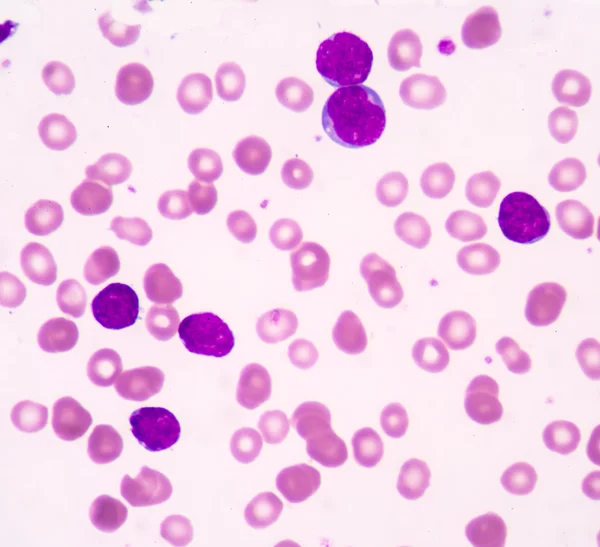 Leucemia linfoblastica acuta (LLA ) — Foto Stock