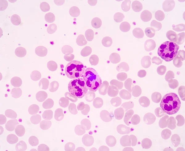 Hypersegmented neutrofilów. Białe ciałka krwi człowieka, photomicrograph panorama widziana pod mikroskopem — Zdjęcie stockowe