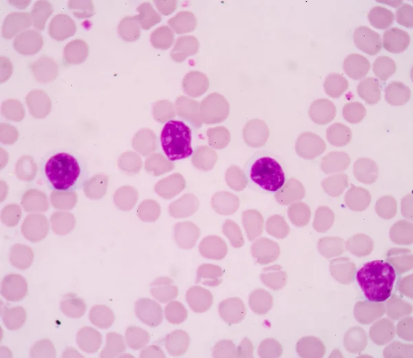 Chronic lymphocytic Leukemia(CLL) — Stock Photo, Image