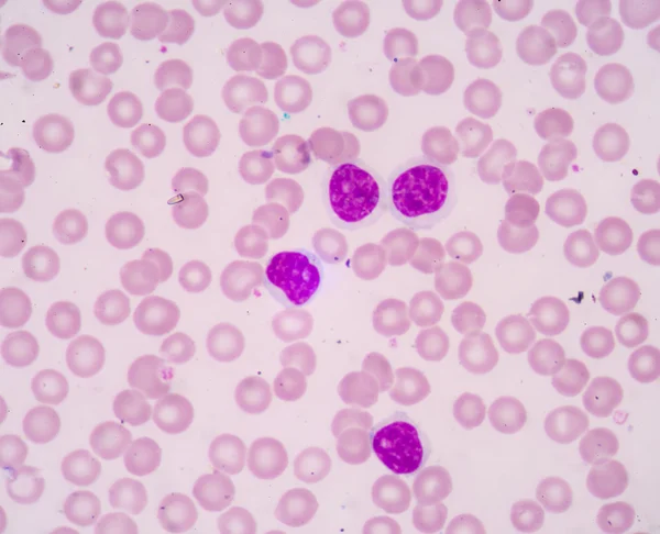 Leucemia linfocítica crónica (LLC) ) — Fotografia de Stock