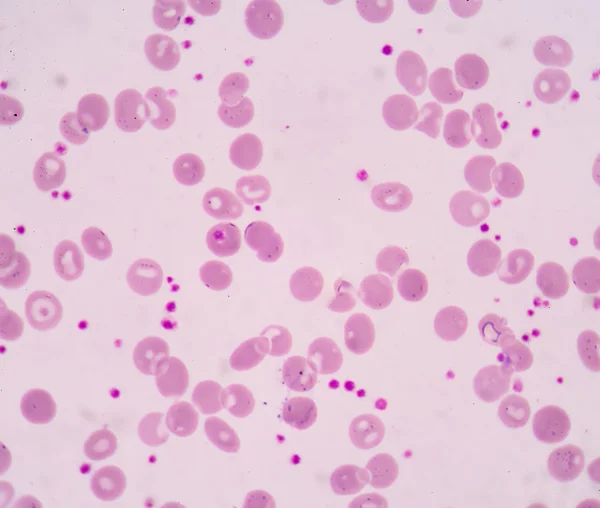 Aumento de plaquetas.Un frotis de sangre se utiliza a menudo como — Foto de Stock