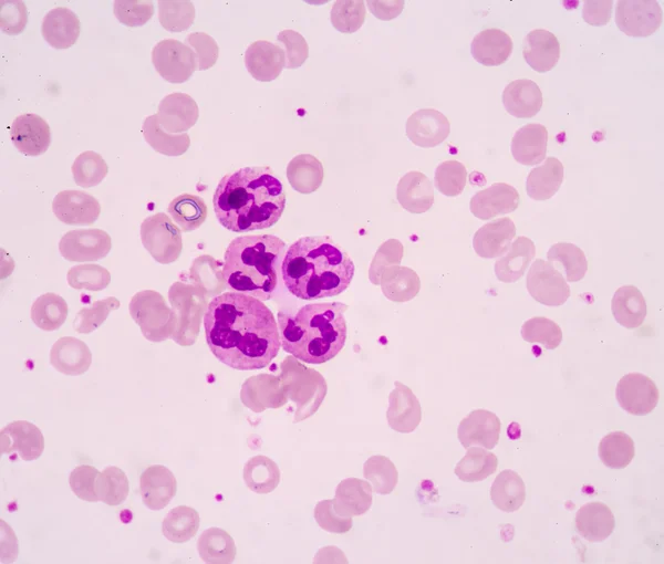 Hypersegmented neutrophil입니다. 인간, 현미경 아래에서 본 photomicrograph 파노라마의 백혈구 세포 — 스톡 사진