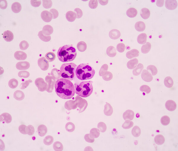 Hypersegmented neutrophil.White blood cells of a human, photomicrograph panorama as seen under the microscope