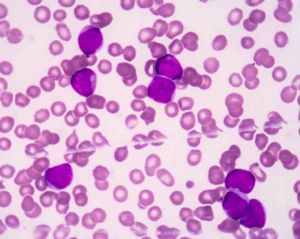 Acute myeloblastic leukemia(AML) — Stock Photo, Image