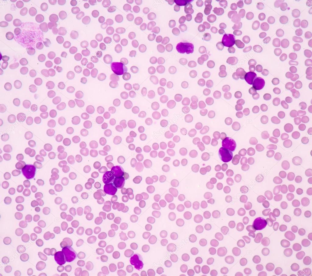 acute myeloblastic leukemia(AML)
