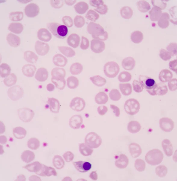 Un glóbulo rojo nucleado, o NRBC, es un glóbulo rojo (RBC) t —  Fotos de Stock