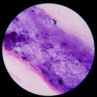 gram pozitif cocci