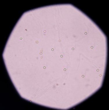 İdrarda taze kırmızı kan hücreleri.