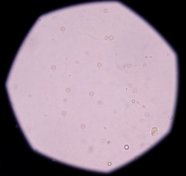 İdrarda taze kırmızı kan hücreleri.