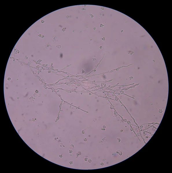 Elágazó kezdő élesztő-sejtek a pseudohyphae a vizeletben — Stock Fotó