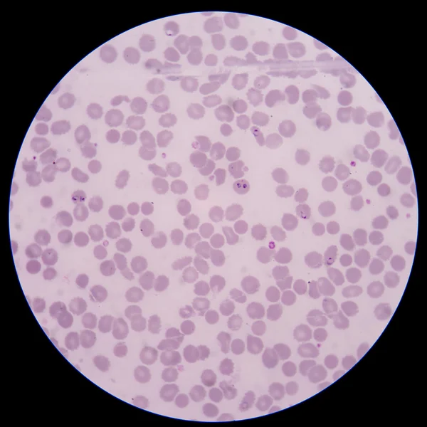 Кров'яний мазок: паразит малярії: плазмодієвий мальфарум (p.f),рід — стокове фото