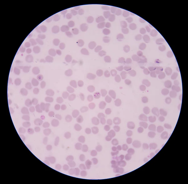 Κηλίδα αίματος: παράσιτο ελονοσία: Plasmodium facifarum (p.f), rin — Φωτογραφία Αρχείου