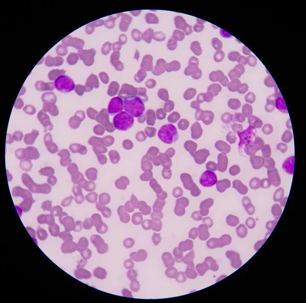 Blood cancer.The smear shows large number of cancer leukemia cel — Stock Photo, Image