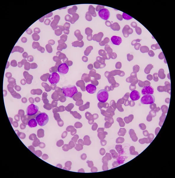 Рак крови. Мазок показывает большое количество лейкоза. — стоковое фото