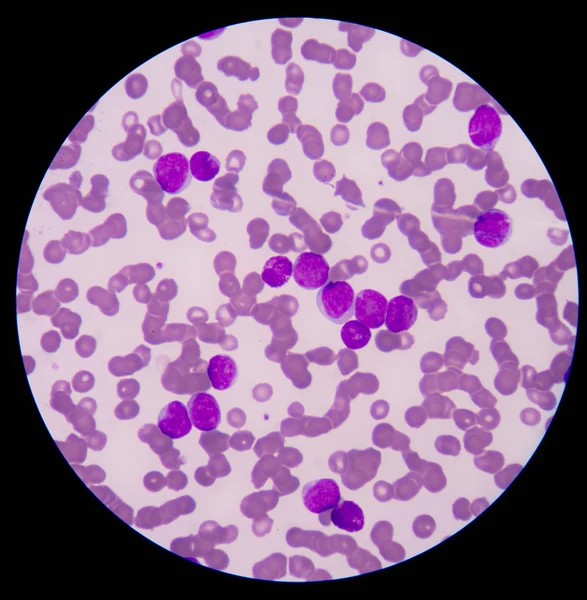 Câncer de Sangue.O esfregaço mostra grande número de células de leucemia de câncer — Fotografia de Stock