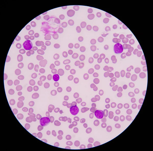 Blood cancer.The smear shows large number of cancer leukemia cel — Stock Photo, Image