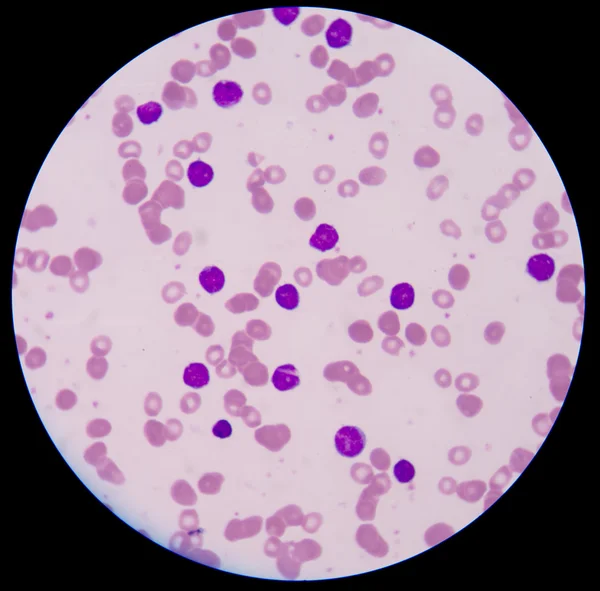 Cáncer de sangre.La citología muestra un gran número de casos de leucemia por cáncer —  Fotos de Stock