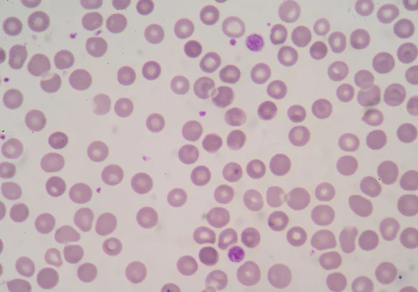 Των αιμοπεταλίων και των λευκών κυττάρων αίματος, μικροσκοπική — Φωτογραφία Αρχείου