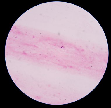 gram pozitif cocci