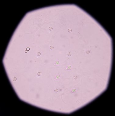calcium oxalate crystal in urine analysis. clipart