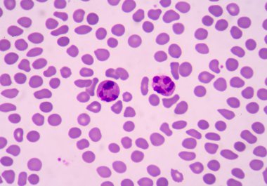 blood smear is often used as a follow-up test to abnormal result clipart
