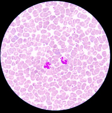 Blood smear form sepsis.septicemia can progress to sepsis.  clipart