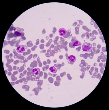 Kan smear formu sepsis.septicemia sepsis için devam edebileceği. 