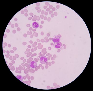 Kan smear formu sepsis.septicemia sepsis için devam edebileceği. 