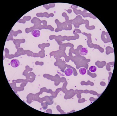 Kan smear formu sepsis.septicemia sepsis için devam edebileceği. 