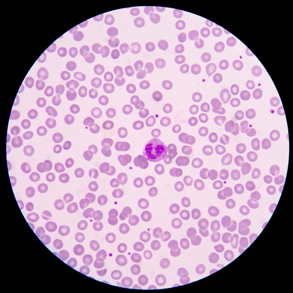 The blood smear. — Stock Photo, Image