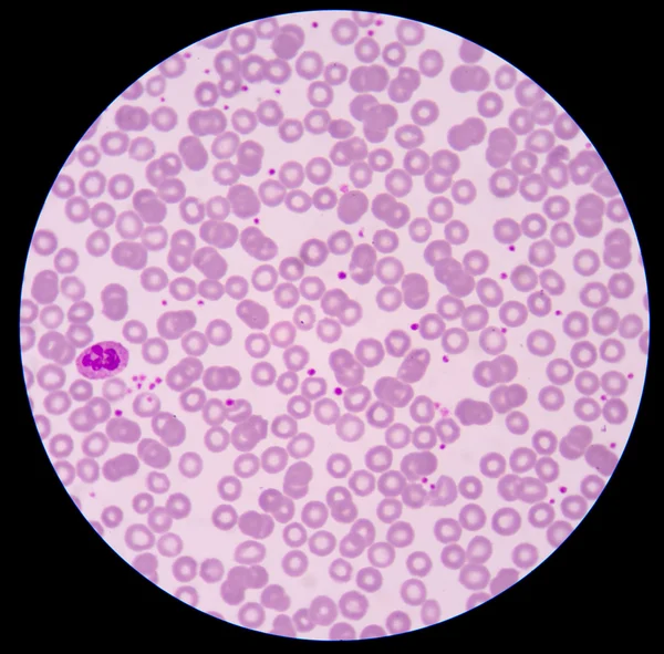 The blood smear. — Stock Photo, Image