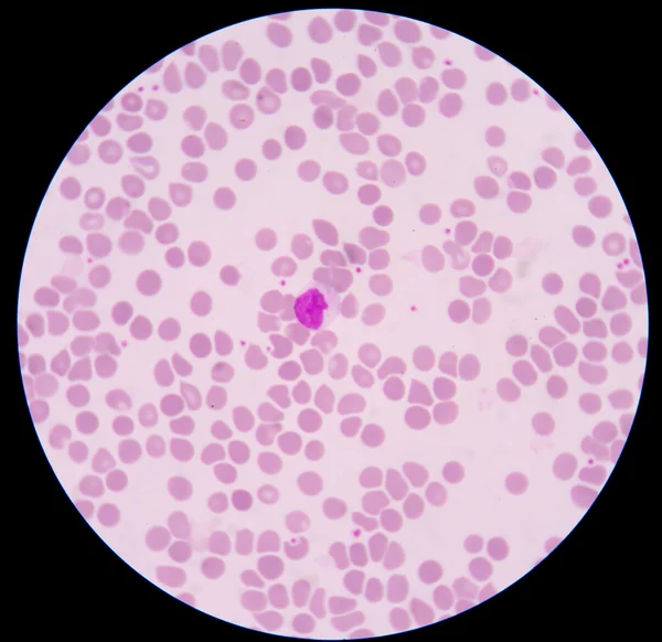 The blood smear. — Stock Photo, Image