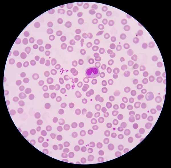 The blood smear. — Stock Photo, Image