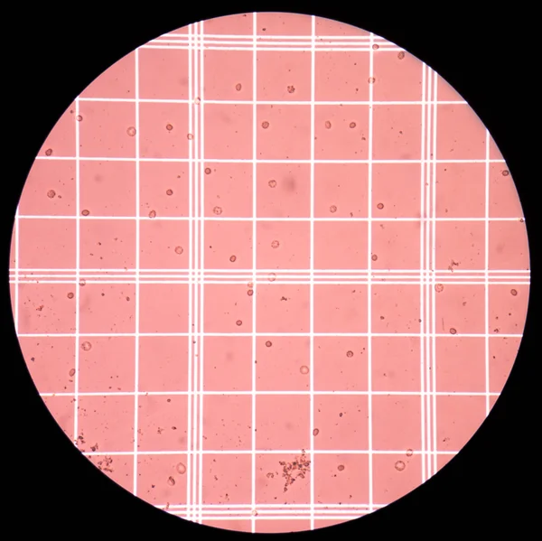 Fresh red blood  cells in CSF fluid sample on scale counting cha — Stock Photo, Image