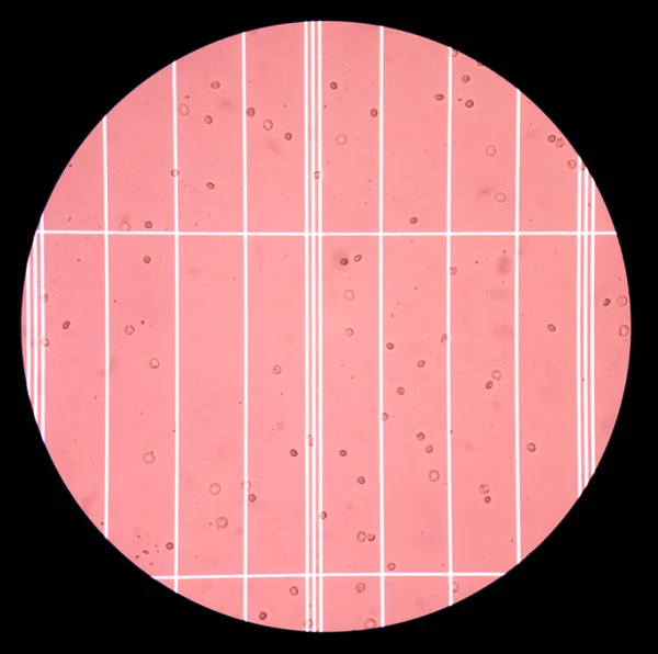 Čerstvé červené krvinky v Csf tekutiny vzorku v měřítku počítání cha — Stock fotografie