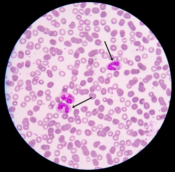 Рак крови. Мазок показывает большое количество раковых лейкоцитов (большие синие клетки) с меньшими красными или розовыми нормальными красными клетками крови или эритроцитами. . — стоковое фото