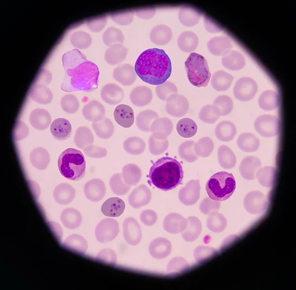 血液のがん。塗抹標本は、がんの数が多い白血病細胞 (大きい青細胞) ピンク正常赤血球または赤血球より小さい赤. — ストック写真