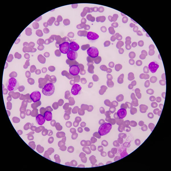 Câncer de Sangue.O esfregaço mostra grande número de células de leucemia de câncer — Fotografia de Stock