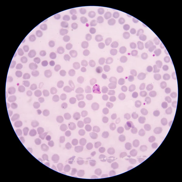 Blood smear Malaria parasite positive in thin film. — Stock Photo, Image