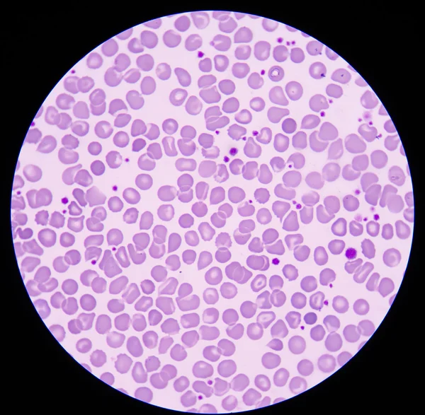 Кров'яний мазок часто використовується як наступний тест на аномальний результат — стокове фото