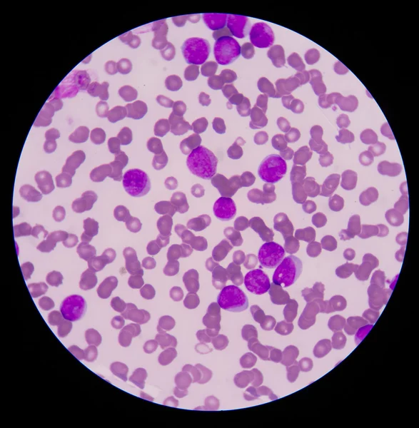 Blood smear is often used as a follow-up test to abnormal result — Stock Photo, Image