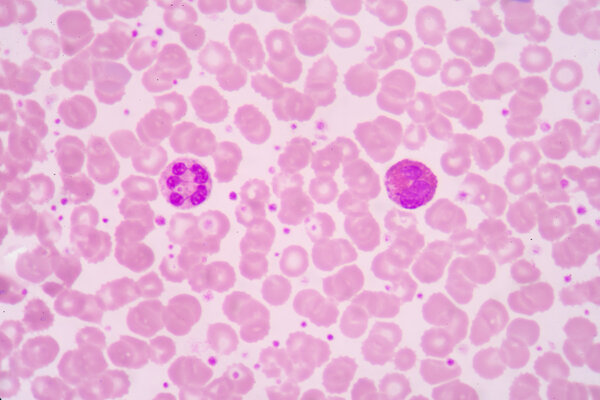 blood smear is often used as a follow-up test to abnormal result