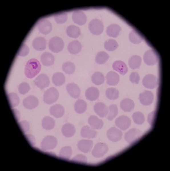 Blood films for Malaria parasite.show malaria pigment. — Stock Photo, Image