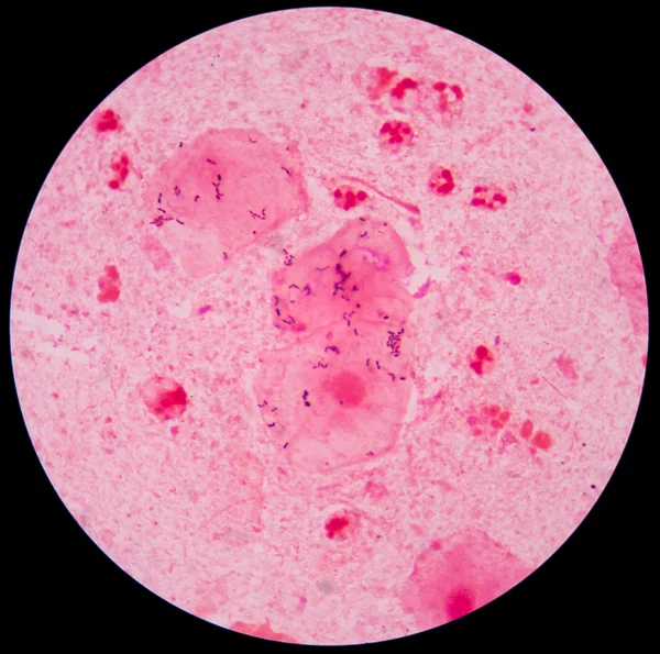 Czerwony leukocytów w plwocinie grama plama z bakterii — Zdjęcie stockowe