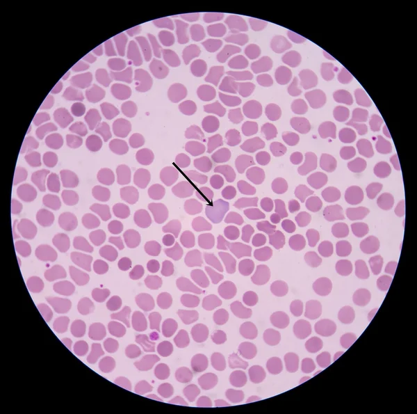 Polychromasia egy betegség hol van egy piros vér sejtek rendellenesen magas száma — Stock Fotó