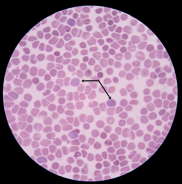 Polychromasia bir bozukluk olan kırmızı kan hücrelerinin anormal derecede yüksek bir sayı olduğu — Stok fotoğraf
