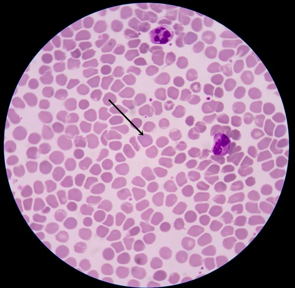 Polychromasie ist eine Erkrankung, bei der es eine ungewöhnlich hohe Anzahl roter Blutkörperchen gibt — Stockfoto