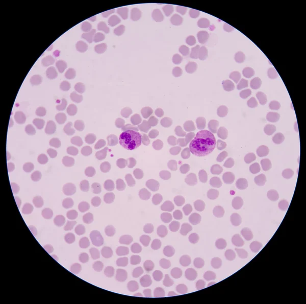 Blood smear form sepsis.septicemia can progress to sepsis. — Stock Photo, Image