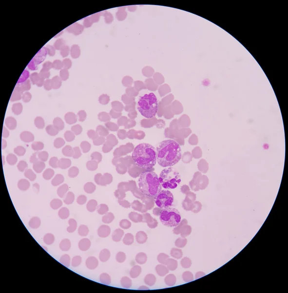 Blood smear form sepsis.septicemia can progress to sepsis. — Stock Photo, Image