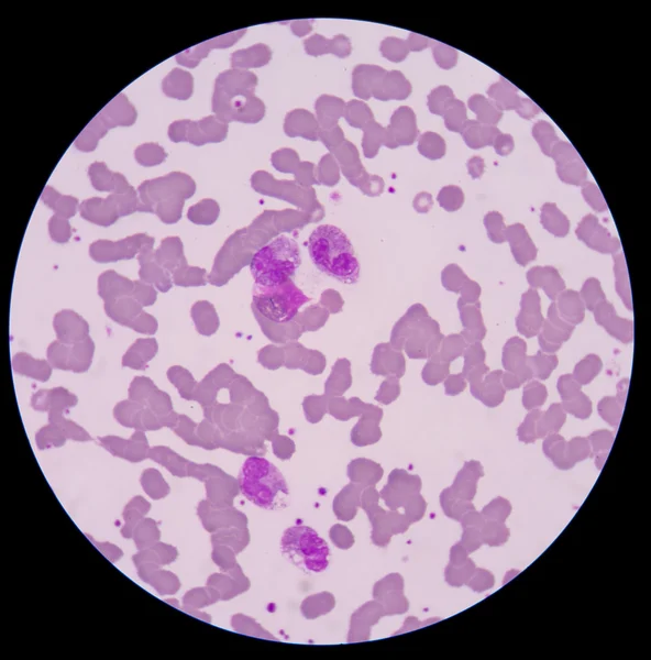 Blood smear form sepsis.septicemia can progress to sepsis. — Stock Photo, Image